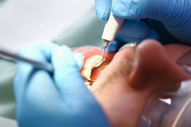 Best Knocked-Out Tooth (Avulsed Tooth) Treatment in Franklinville, NC